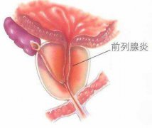 急性细菌性前列腺炎的发病原因